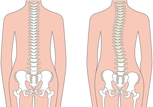Low back pain due to spinal deformities such as scoliosis