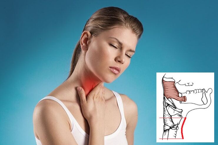 Sore throat with cervical osteochondrosis due to compression of the nerves