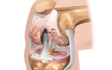Ligament scheme