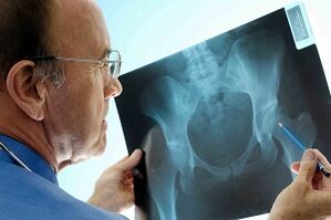 Arthrosis of the hip joint on the radius X