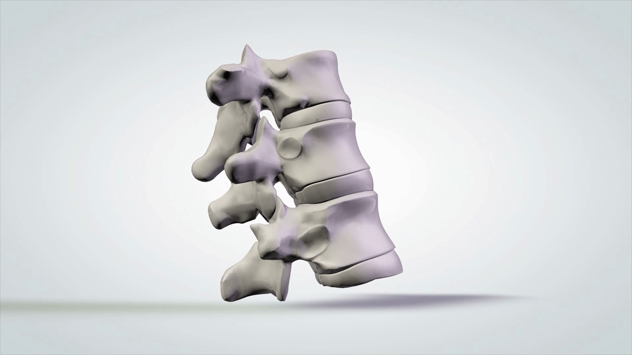 damage to the spine due to cervical osteochondrosis