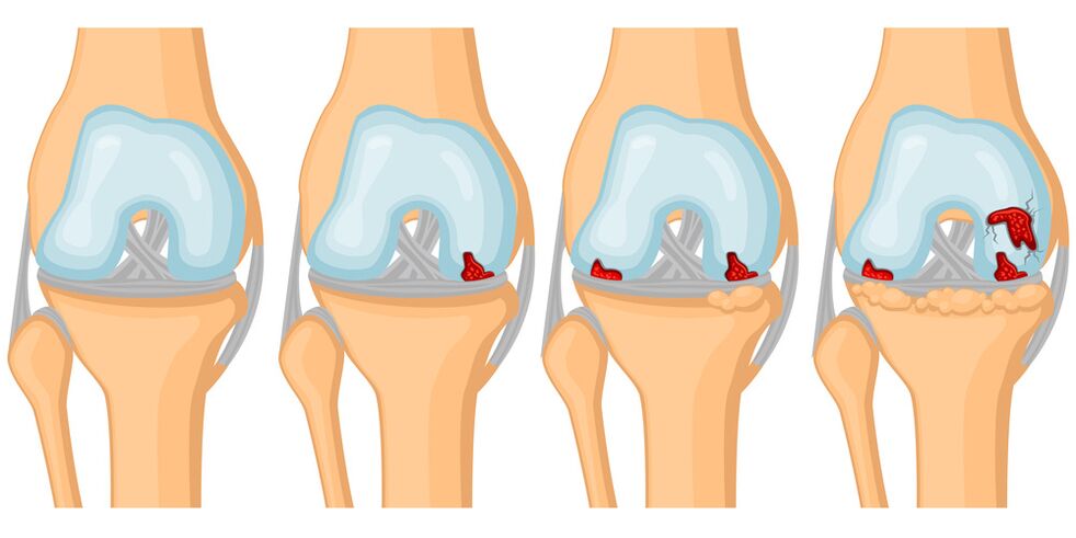 Degree of development of joint arthrosis